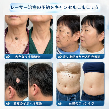 公式ストア🎉7日間スポット＆シミ除去ケア （ゼロ痛み・ゼロダメージ ローラーボール）💧