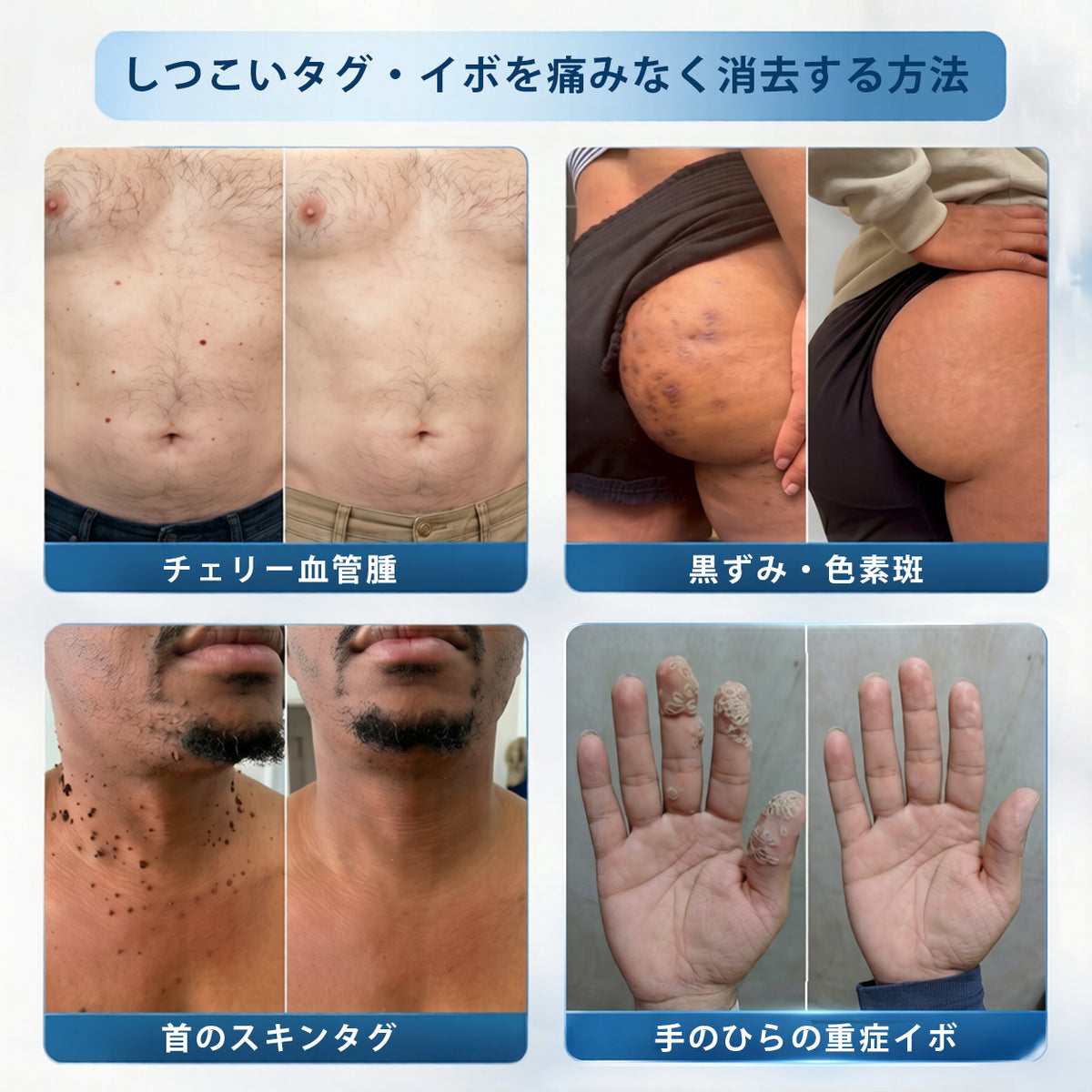 公式ストア🎉7日間スポット＆シミ除去ケア （ゼロ痛み・ゼロダメージ ローラーボール）💧