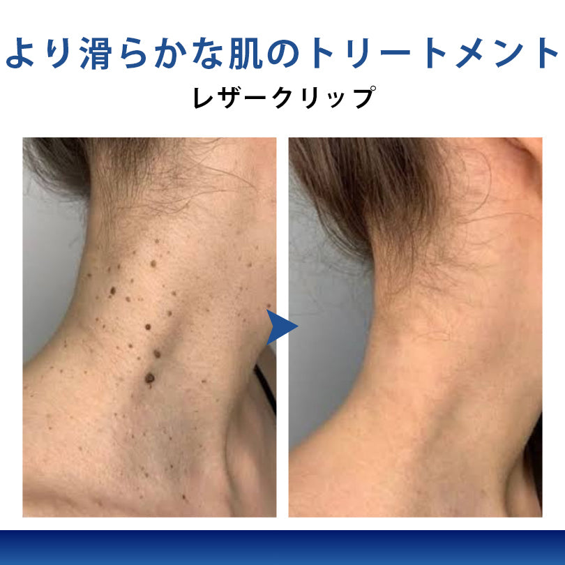 🫘Mickey® ダブルアクション ハイドロコロイド マイクロニードルパッチ